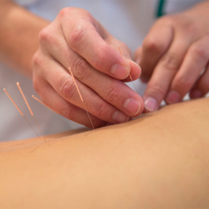 acupuncture-treatment